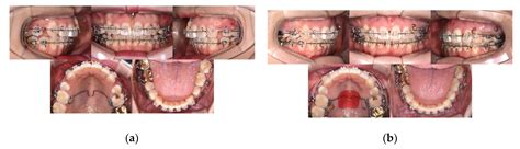 牙齒丟屋頂|牙齒掉了丟屋頂？ – 黃郁芩醫師 Orthodontics